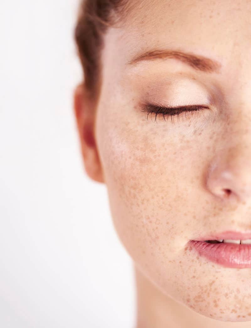 Facial Hyperpigmentation0