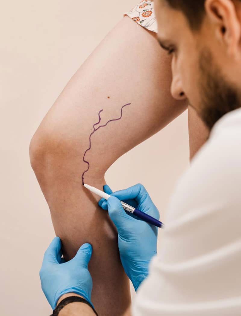 Spider Vein0